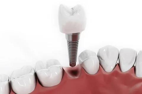 dental implants Mascot