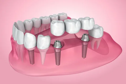 dental implants Mascot